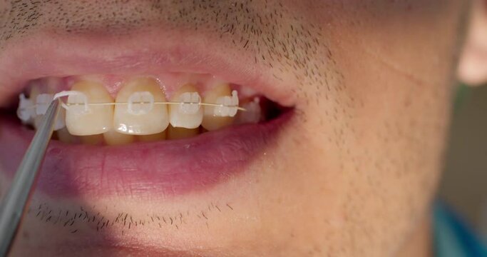 Close-up male open mouth with ceramic braces on the teeth and orthodontist is using dental forceps to putting white ligature ties on braces. The patient is having orthodontic treatment.