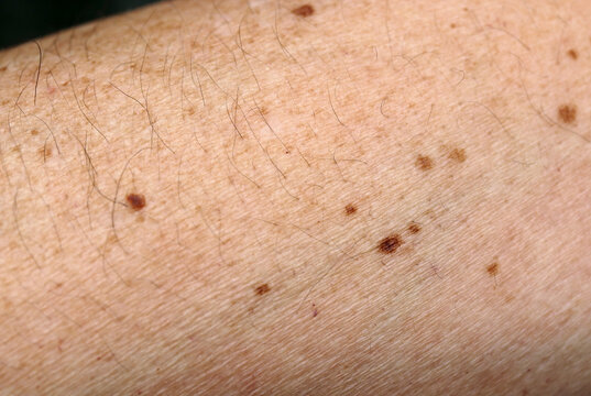 Gef&auml;hrliche oder ungef&auml;hrliche Pigmentflecken auf der Haut. 