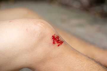 Person with fresh bleeding wounds on the knees The damage is treated with an adhesive bandage, to prevent the blood from flowing. closeup