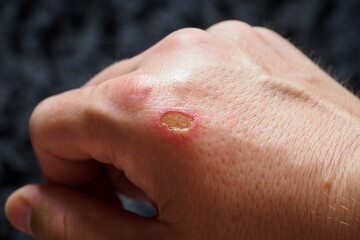 Fototapeta premium Damaged small part of the skin after a burn on a person's right hand.