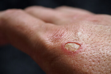 Damaged small part of the skin after a burn on a person's right hand.