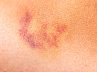 bruise on the skin