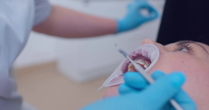 Close-up open mouth with optragate of a female patient and on the teeth is a bracket system, the medical hand is taking out details from upper jaw with the braces by using a dental probe.