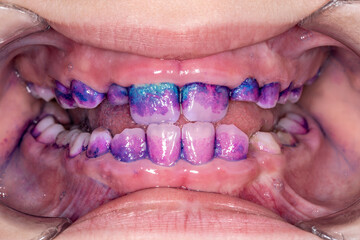 Colored plaque on a child's teeth close-up.Front view of human teeth.Permanent and deciduous teeth...