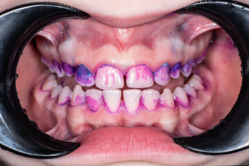Colored plaque on a child's teeth close-up.Front view of human teeth.Permanent teeth in the...