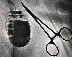 X ray image during permanent pacemaker implantation procedure.	