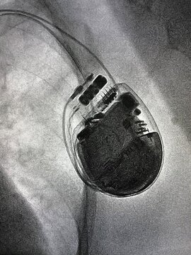 X ray image during permanent pacemaker implantation procedure.	
