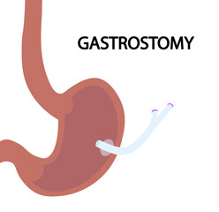 Gastrostomy illustration. Enteral nutrition feeding by gastrostomy tube. 
