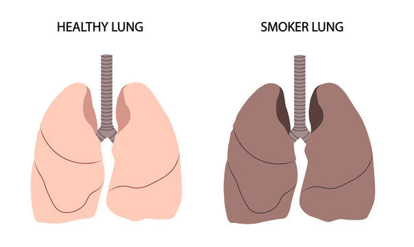 Healthy versus smoker lung illustration. 