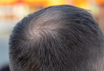 Close-up of a bald spot on a man's head.