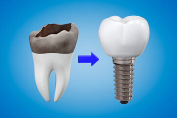 The concept of replacing a damaged tooth with an implant. Carious tooth and implant with a crown. 3d rendering.