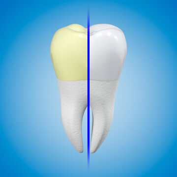 Tooth whitening concept. A tooth with yellow plaque and a white tooth with shiny enamel in comparison. 3d rendering.