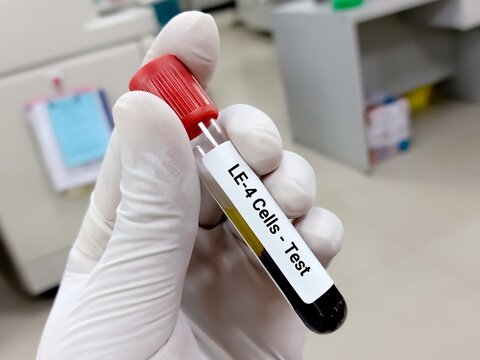 Blood Sample For LE-4 Cells Test, Lupus Erythematosus. A Medical Testing Concept.