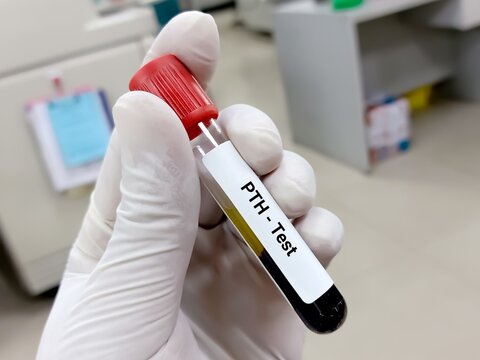 Test Tube with blood sample for Parathyroid Hormone (PTH) test, diagnosis for organ disease. A medical testing concept in the laboratory background.
