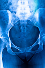 Hips pelvis xray scan
