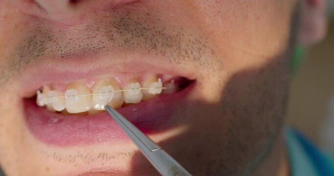 Close-up male open mouth with ceramic braces on the teeth and orthodontist is using dental forceps to putting white ligature ties on braces. The patient is having orthodontic treatment.