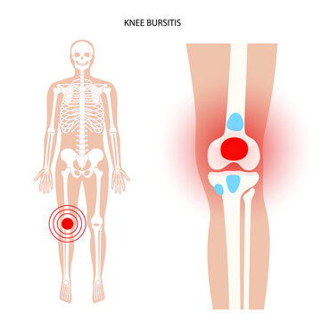 Bursitis inflammation concept