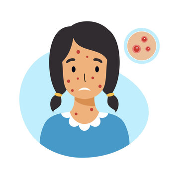 Sad  Girl With Chicken Pox On Her Face. Skin Inflammation And Acne In Adolescents.