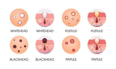 set different facial skin pimples acne types pore comedones cosmetology skincare problems concept flat horizontal