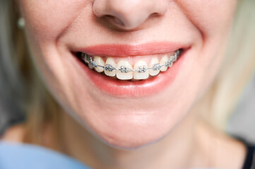 Close up of woman with charming smile demonstrating white teeth with orthodontic brackets. Female...