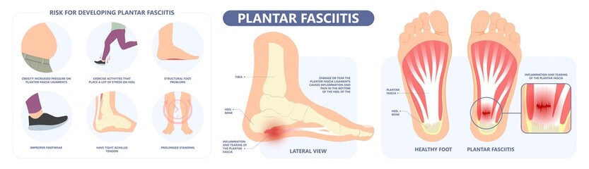 Plantar Fasciitis Heel pain run foot bone toes tear strain sport injury arch Shock Wave flat feet fallen pes planus Tendon tight hollow cavus high curved spur bony ankle band torn