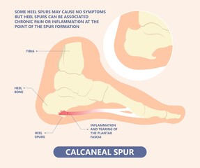 Plantar Fasciitis Heel pain run foot bone toes tear strain sport injury arch Shock Wave flat feet fallen pes planus Tendon tight hollow cavus high curved spur bony ankle band torn