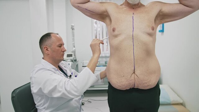 Plastic doctor drawing lines on patient's body. Surgeon doing markup on a man's body before the plastic surgery in clinic.