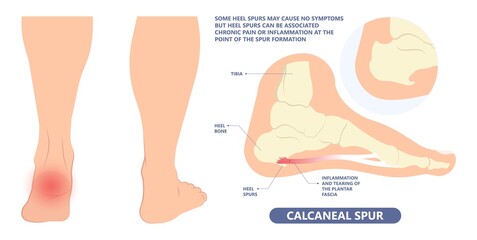 Plantar Fasciitis Heel pain run foot bone toes tear strain sport injury arch Shock Wave flat feet fallen pes planus Tendon tight hollow cavus high curved spur bony ankle band torn