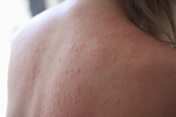 Woman injured back with rash and red sun spots