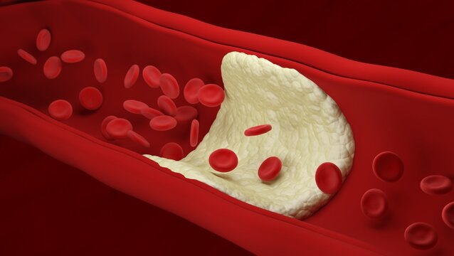 Atherosclerosis. Red blood cells.  Artery. Build up of plaque. Loss of elasticity of the walls of arteries. Thickening and hardening. Blood flow. 3d illustration.
