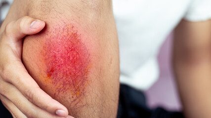 Close-up view of hind legs After the accident, traumatic pain, burns.