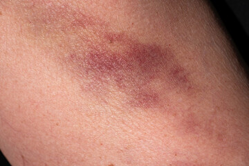 Bruise on the skin of a woman's upper arm. Black background