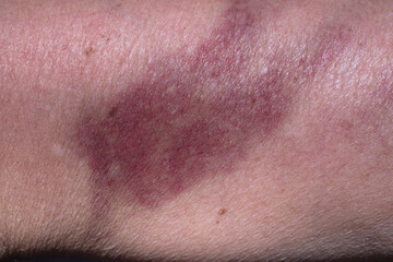 Bruise on the skin of a woman's upper arm, caused by an injury