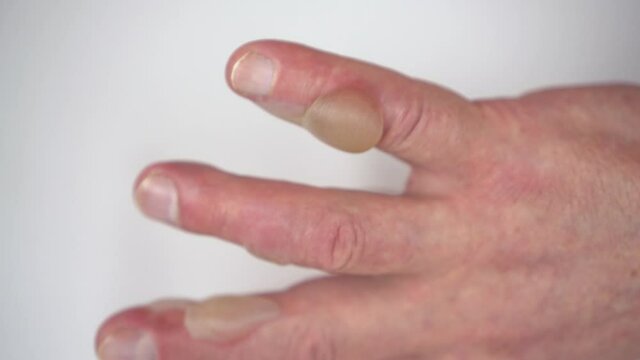 Burn of a man's hand with hot water 