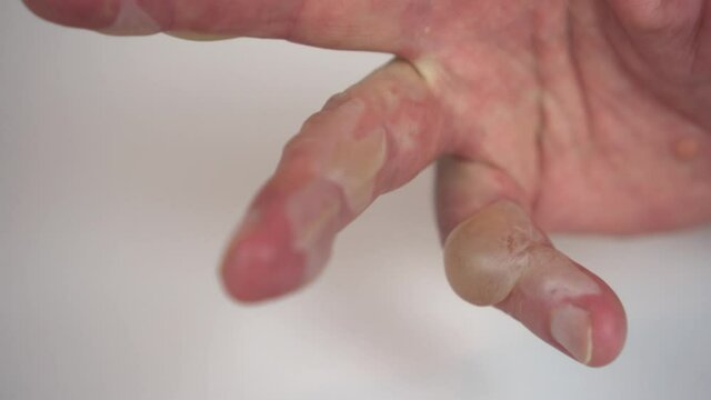 Burn of a man's hand with hot water 