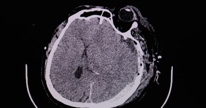 A CT scan of the brain of a patient with accident showing acute subdural hematoma and marked cerebral edema. Diagnostic CT footage.