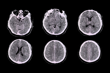 CT brain of a patient with Strptococcus meningitis.