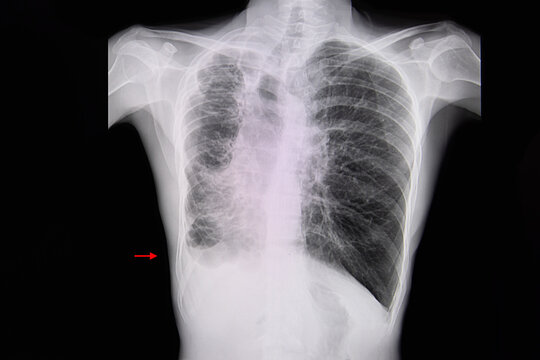 Chest xray film of a patient with bronchiectasis.