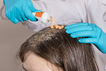 A dermatologist or trichologist applies a dandruff or lice weed to the patient's hair. Treating psoriasis, hair loss, dermatitis or head lice.