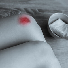 Black and white photo of young woman with large wound on knee