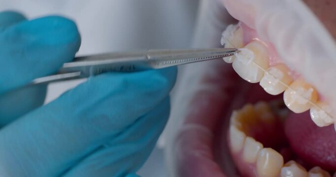 Close-up male open mouth with ceramic braces on the teeth and orthodontist is using dental forceps to putting and taking out white ligature ties on braces.