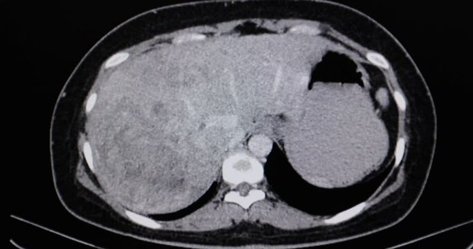 A motion CT scan of an abdomen of a patient with primary liver cancer. Diagnostic CT footage.