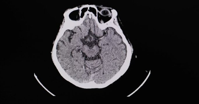 A CT scan of the brain of a patient  subdural hematoma.  Diagnostic CT footage. Animated or animation CT film.