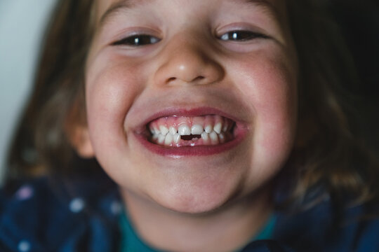Little Girl Showing Two Missing Teeth