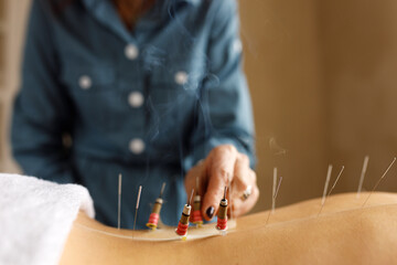 Unrecognizable woman acupuncturist working with moza, burning mugwort close to skin on back, using acupuncture needles to enhance qi movement. Energy, health, vitality and wellness concept - obrazy, fototapety, plakaty