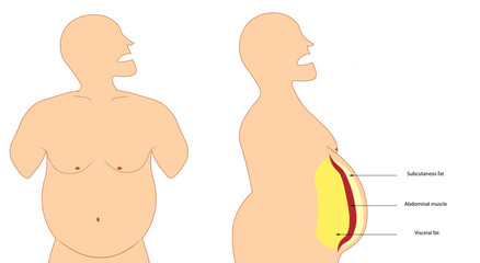 Obesity illustration. Visceral and subcutaneous fat. Front and side view of a obese man - obrazy, fototapety, plakaty