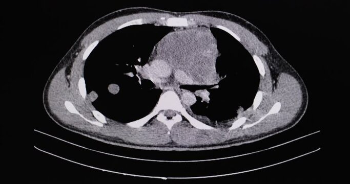 CT cine scan of the chest and abdomen of a patient with lymphoma showing lymph nodes and liver enlargements and metastatic masses in the liver and lungs.