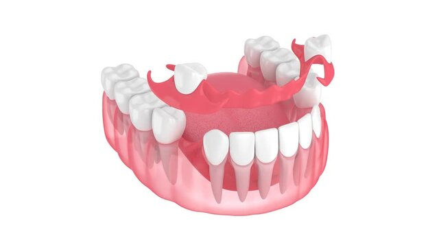Jaw with removable partial denture isolated over white background
