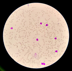 Iron deficiency anemia, microscope 40x and 100x objective showing small hypochromic red blood...