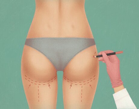 Surgeon drawing marks on female body before plastic operation.